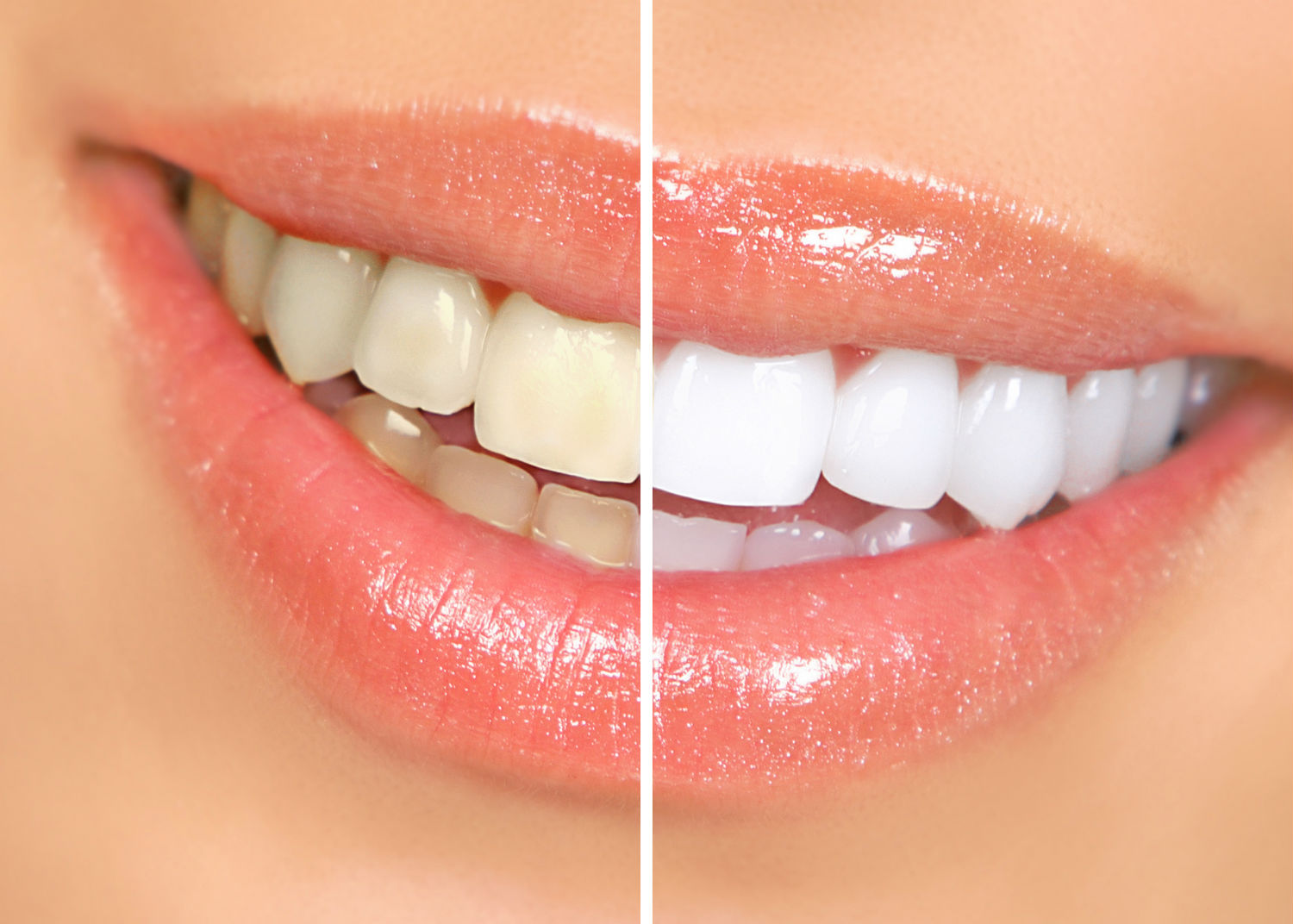 September 2020 - Teeth Whitening Before and After