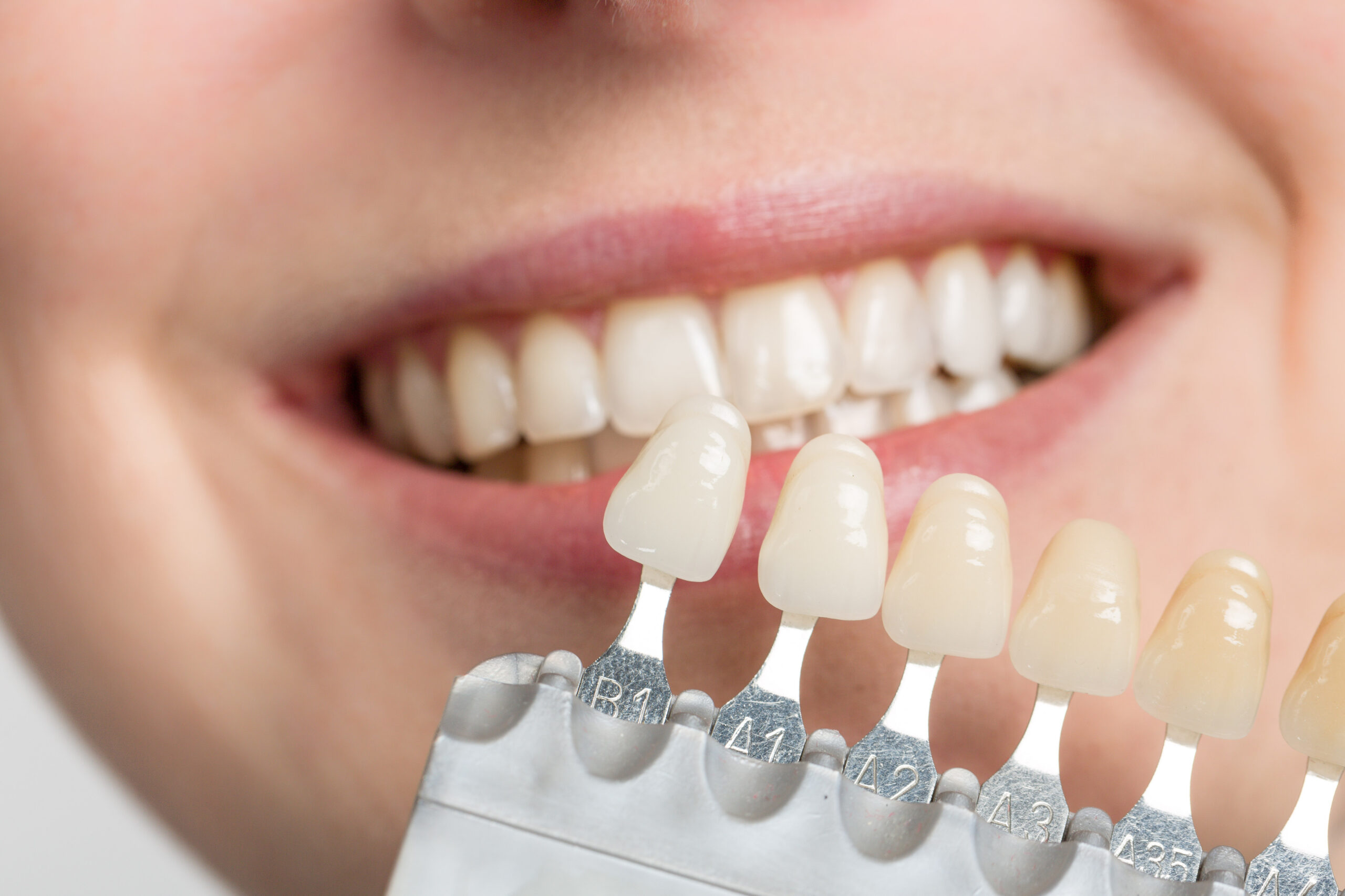 Veneers vs Lumineers McCue Dental Health