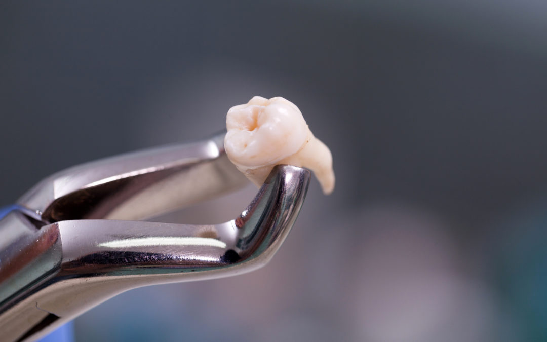 Tooth Extraction Healing Timeline: What to Expect
