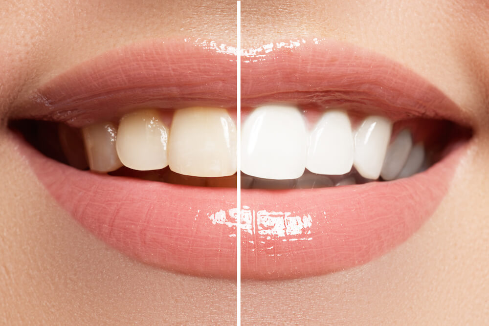 Wauwatosa cosmetic dentist Wauwatosa cosmetic dentist