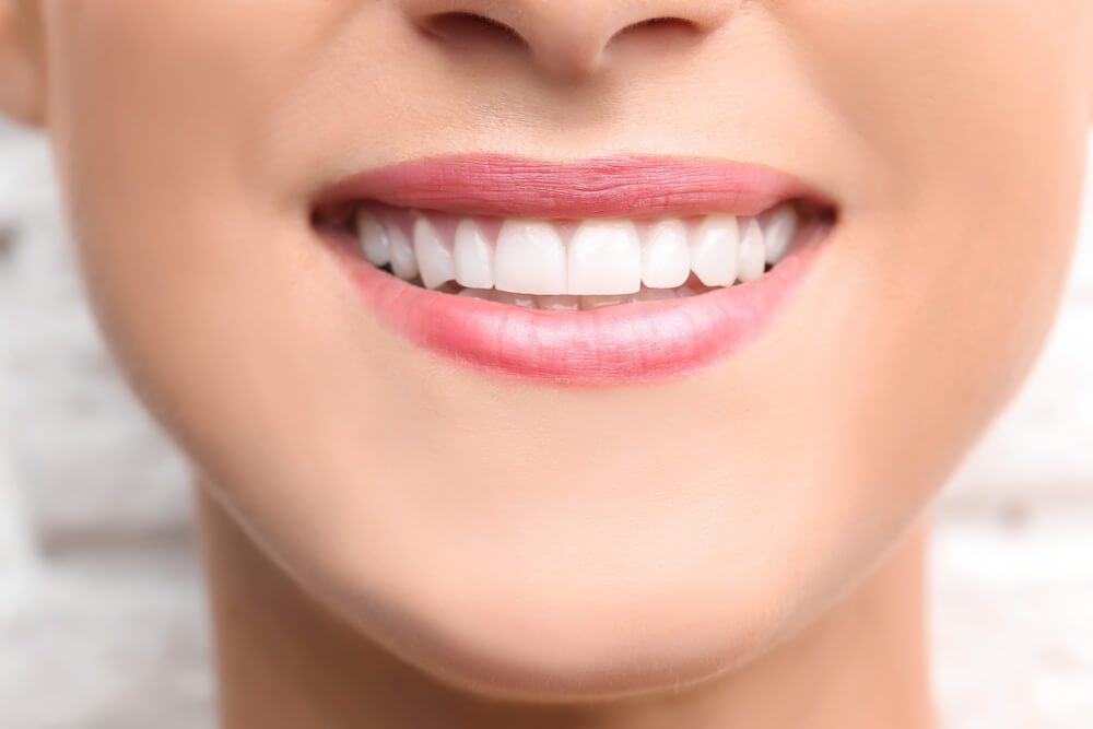 What to Avoid After Teeth Whitening Treatment