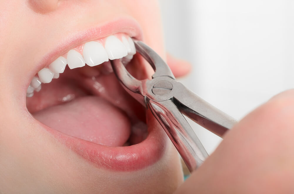 tooth extractions in Wauwatosa