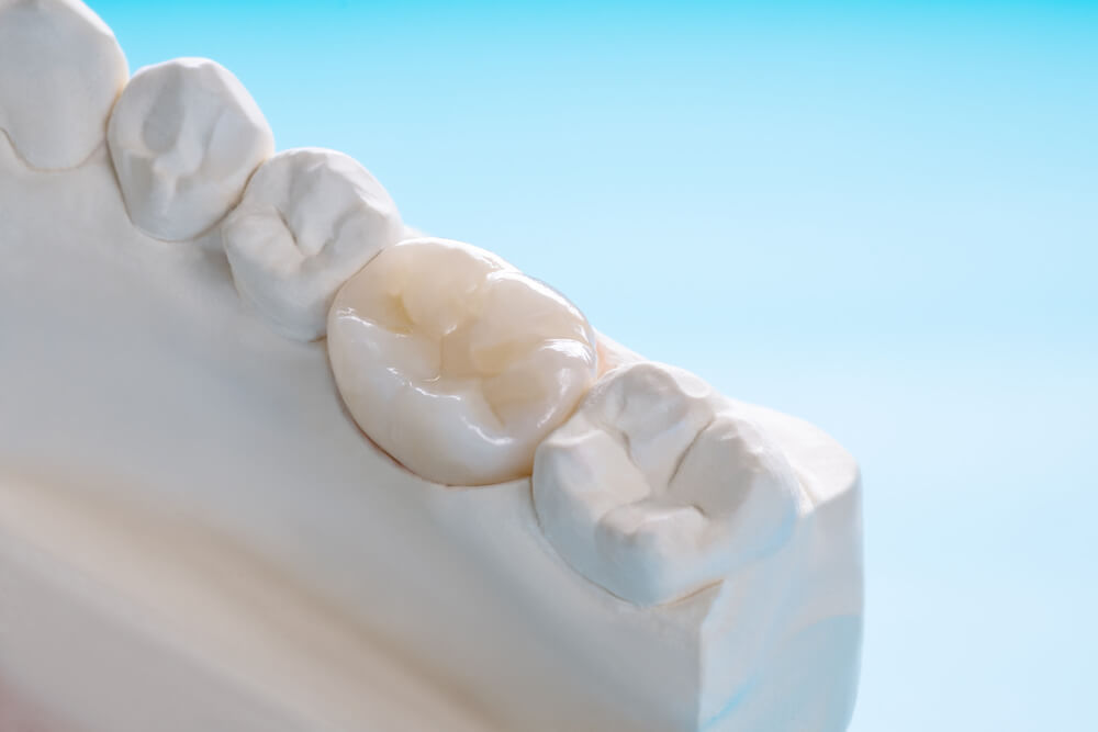 What Is The Lifespan Of A Dental Crown?