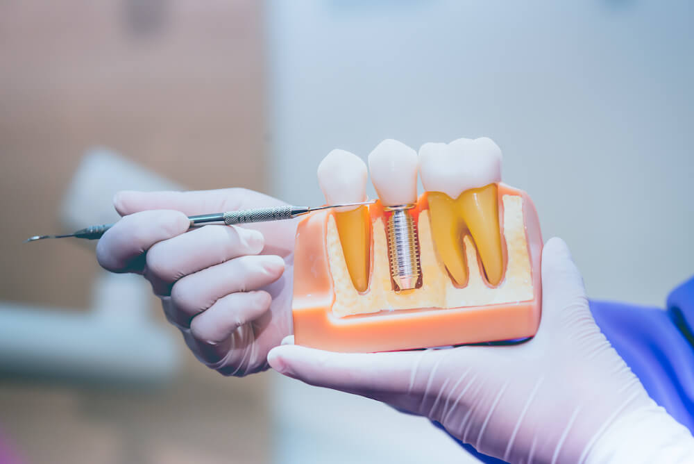 How Long Do Dental Implants Last?