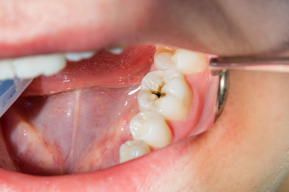 Can Veneers Get Cavities?