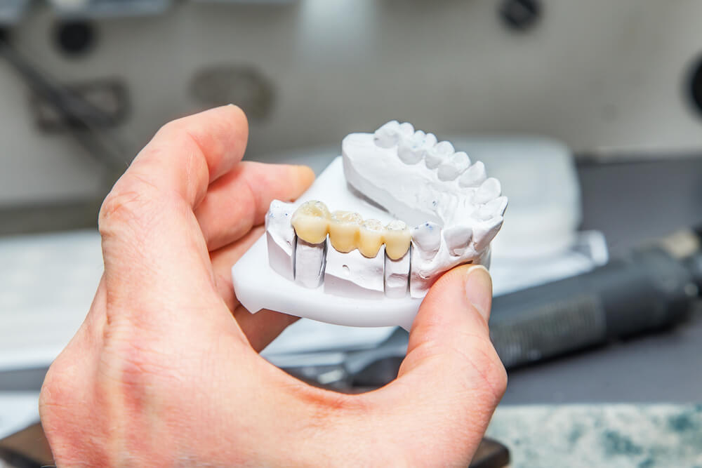 Are Mini Implants as Good as Traditional Dental Implants?