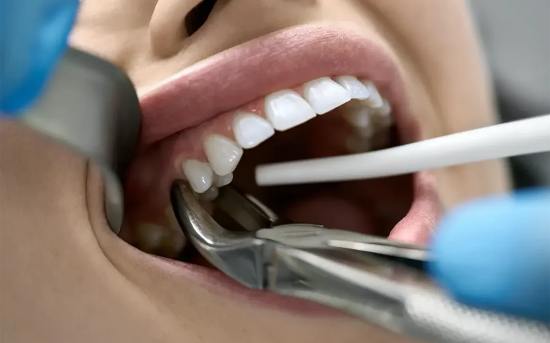 How Long Does a Tooth Extraction Take?